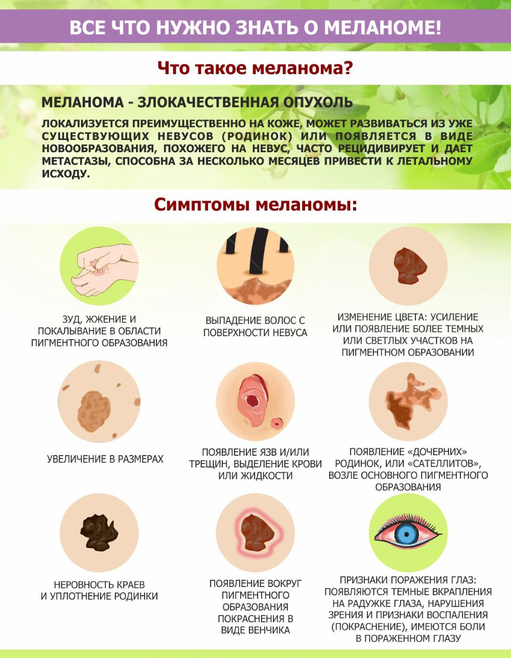 Всё, что нужно знать о меланоме!