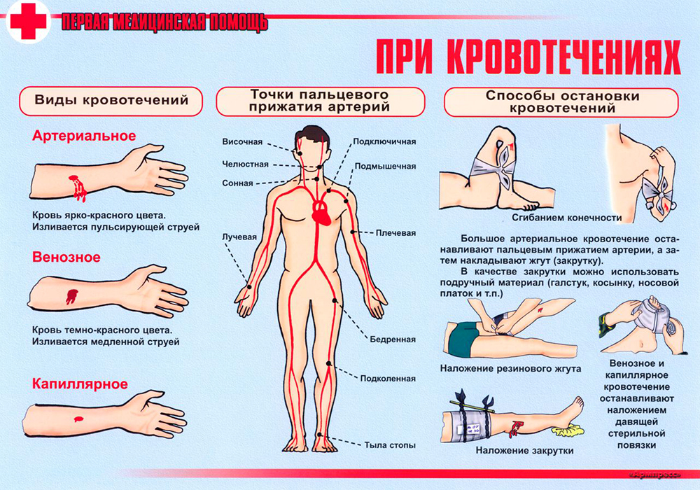 Первая медицинская помощь при кровотечениях