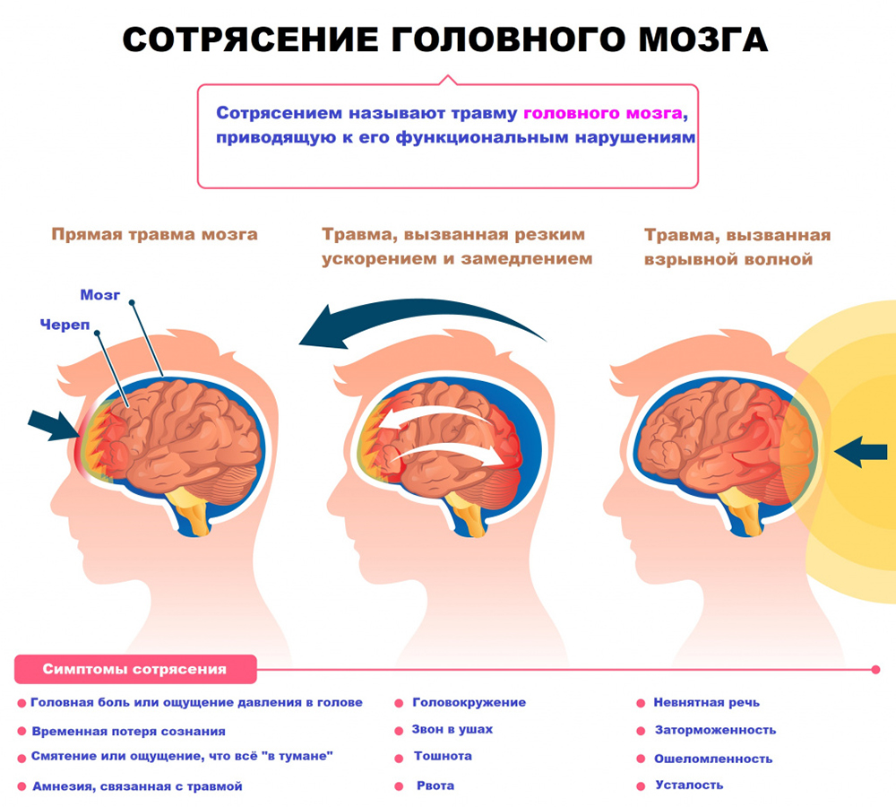 Сотрясение головного мозга