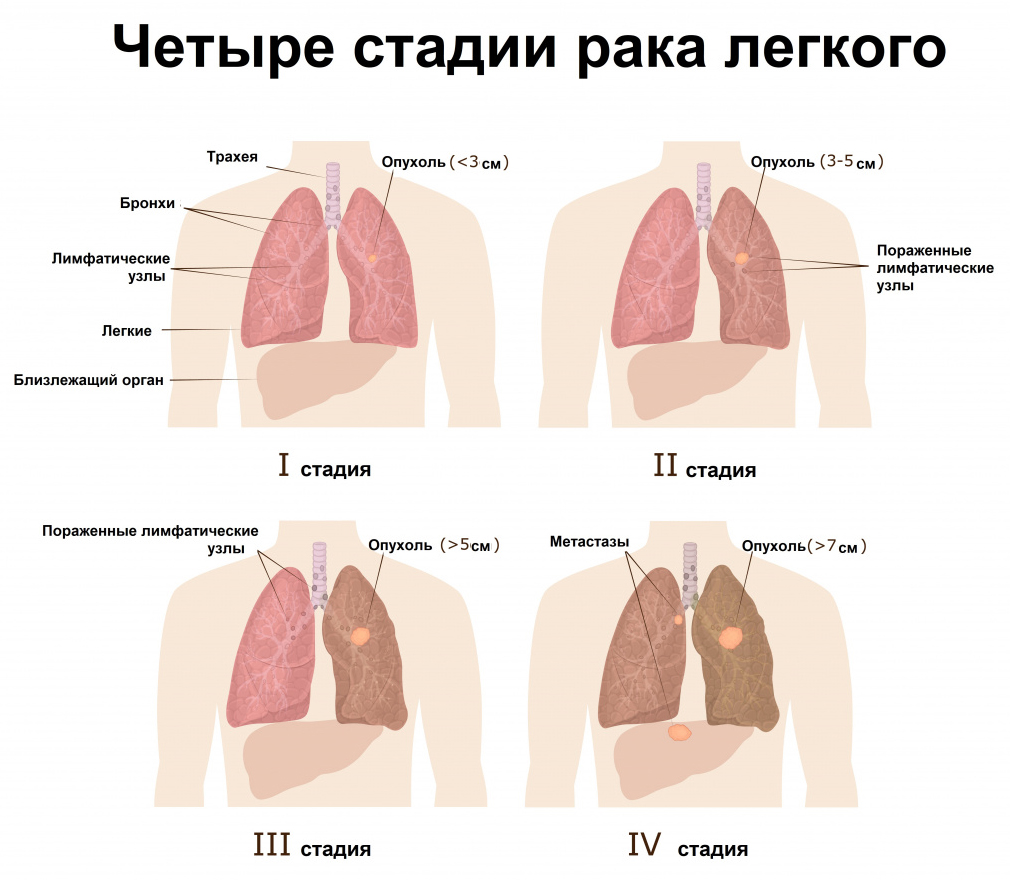 Четыре стадии рака лёгкого