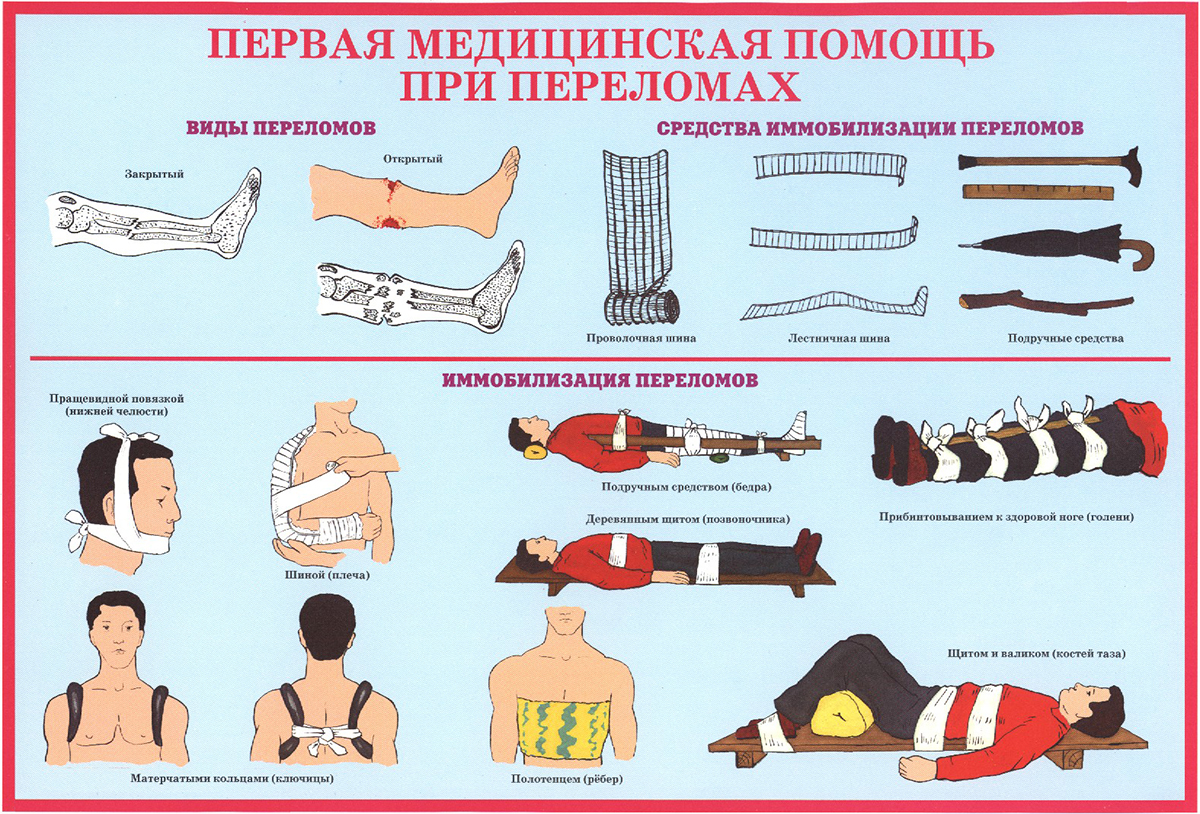 Первая медицинская помощь при переломах